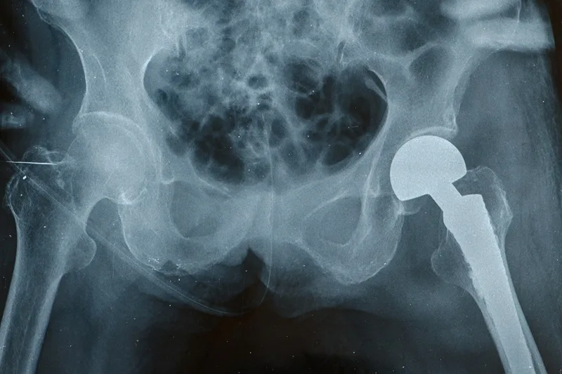 Prótesis total de cadera